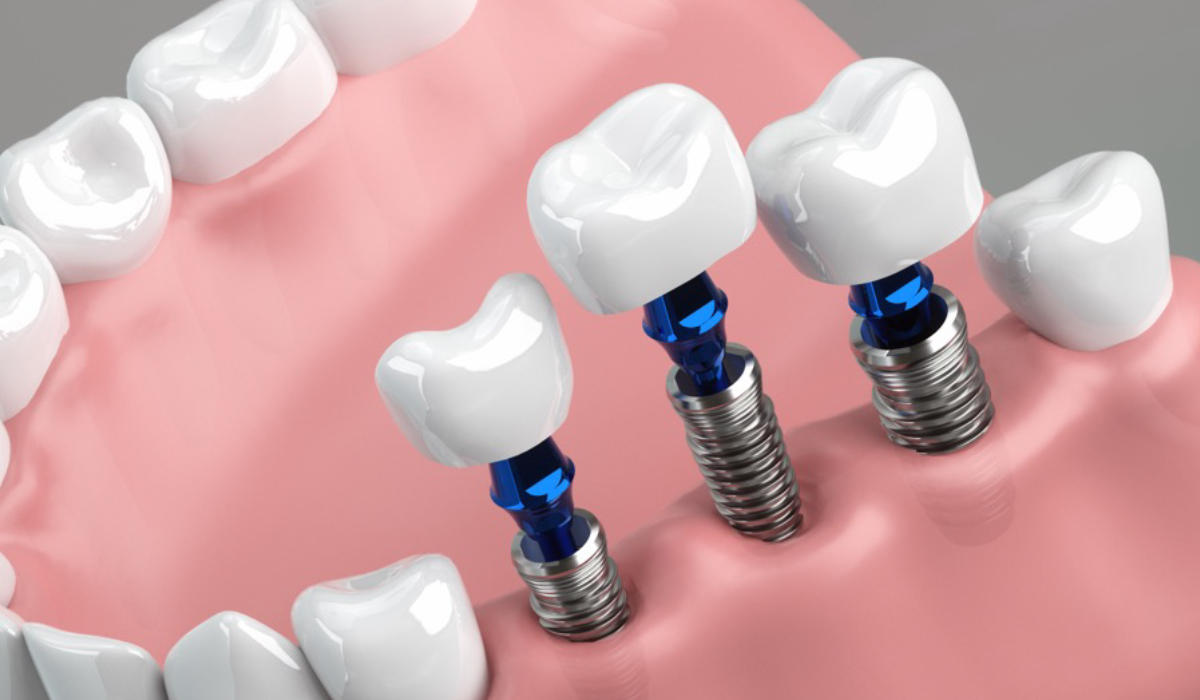 奥歯のインプラントと治療の特徴